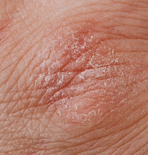 Damaged Skin Barrier, dry flaky skin