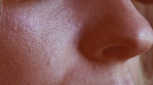 What do enlarged pores look like in women