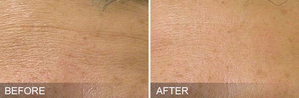 Hydrafacial Before and After Picture 1