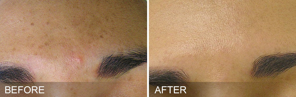 Hydrafacial Before and After Picture 3