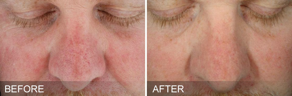 Hydrafacial Before and After Picture 5