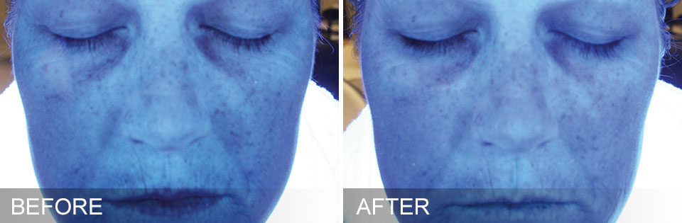 Hydrafacial Before and After Picture 6