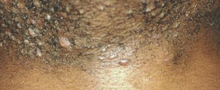 Area on shaving after bumps small pubic Bumps after